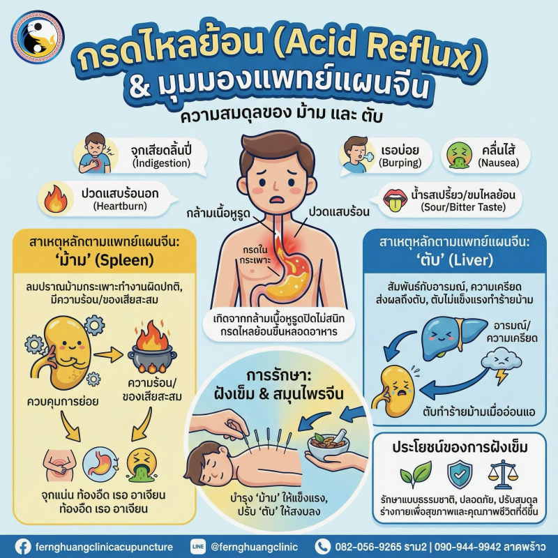 กรดไหลย้อน ฝังเข็ม